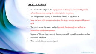 ETIOPATHOGENESIS
• In dentoalveolar ankylosis, the injury results in damage to periodontal ligament
cells and cementum, causing discontinuity in the cementum.
• The cells present in vicinity of the denuded root try to repopulate it.
• Bone precursor cells are more active than the slower moving periodontal ligament
cells.
• They move across the socket wall and populate the damaged root without an
intermediate attachment apparatus.
• Because of this, the bone comes in direct contact with root without an intermediate
attachment apparatus.
• This results in dentoalveolar ankylosis
 