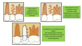 Focal areas of
replacement
ankylosis in the
maxillary second
premolar
Decoronation in the
maxillary second
premolar, with
replacement resorption,
preparing it to receive
an implant in the region.
Installation of an implant in the
region.
The replacement of dental
remnants will follow its natural
course and will not disrupt
osseointegration
 