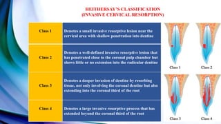 HEITHERSAY’S CLASSIFICATION
(INVASIVE CERVICAL RESORPTION)
Class 1 Denotes a small invasive resorptive lesion near the
cervical area with shallow penetration into dentine
Class 2
Denotes a well-defined invasive resorptive lesion that
has penetrated close to the coronal pulp chamber but
shows little or no extension into the radicular dentine
Class 3
Denotes a deeper invasion of dentine by resorbing
tissue, not only involving the coronal dentine but also
extending into the coronal third of the root
Class 4 Denotes a large invasive resorptive process that has
extended beyond the coronal third of the root
 