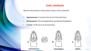 Frank’ s classification
Based on the location of the portal of entry in the cementum
• Supraosseous- Coronal to the level of alveolar bone.
• Intraosseous- Not accompanied by periodontal breakdown.
• Crestal- At the level of alveolar bone
 