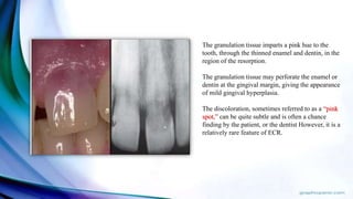 The granulation tissue imparts a pink hue to the
tooth, through the thinned enamel and dentin, in the
region of the resorption.
The granulation tissue may perforate the enamel or
dentin at the gingival margin, giving the appearance
of mild gingival hyperplasia.
The discoloration, sometimes referred to as a “pink
spot,” can be quite subtle and is often a chance
finding by the patient, or the dentist However, it is a
relatively rare feature of ECR.
 