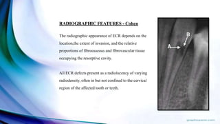 RADIOGRAPHIC FEATURES - Cohen
The radiographic appearance of ECR depends on the
location,the extent of invasion, and the relative
proportions of fibroosseous and fibrovascular tissue
occupying the resorptive cavity.
All ECR defects present as a radiolucency of varying
radiodensity, often in but not confined to the cervical
region of the affected tooth or teeth.
 