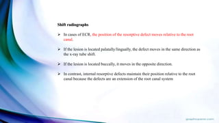 Shift radiographs
 In cases of ECR, the position of the resorptive defect moves relative to the root
canal.
 If the lesion is located palatally/lingually, the defect moves in the same direction as
the x-ray tube shift.
 If the lesion is located buccally, it moves in the opposite direction.
 In contrast, internal resorptive defects maintain their position relative to the root
canal because the defects are an extension of the root canal system
 