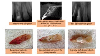 Extraction showing the
resorption defect
Complete debridement of the
resorptive defect
Resorptive defect restored with
Biodentine
Preoperative radiograph
CBCT Sagittal section showing the
extent and location of the
resorption defect
Post-obturation radiograph
 