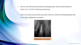 • The case was followed up clinically and radiographically, which showed satisfactory
results at 3, 6, 12 and 18 months post-operatively.
• There was no pain on percussion, percussion sound was normal; and radiographically there
was no sign of replacement resorption.
Radiograph at 18 months.
 