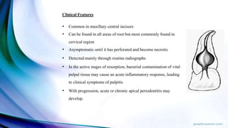 Clinical Features
• Common in maxillary central incisors
• Can be found in all areas of root but most commonly found in
cervical region
• Asymptomatic until it has perforated and become necrotic
• Detected mainly through routine radiographs
• In the active stages of resorption, bacterial contamination of vital
pulpal tissue may cause an acute inflammatory response, leading
to clinical symptoms of pulpitis
• With progression, acute or chronic apical periodontitis may
develop.
 