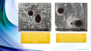 Apex with periforaminal resorption
involving more than half of the
radicular surface examined. The
resorption displayed a honeycomb
aspect.
Apex with foraminal resorption
involving 1/4-1/2 of the perimeter with
a not well defined, or even absent
outline of the interlacunae crests
 