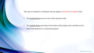 This type of resorption is infrequent and may appear in localized or multiple forms.
• The localized form occurs in one to three posterior teeth.
• The multiple forms may begin in the molars and bicuspids and eventually involve
most of the dentition in a symmetrical pattern
 