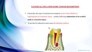 EXTERNAL INFLAMMATORY TOOTH RESORPTION
• Classically, this type of external root resorption occurs when infection is
superimposed on a traumatic injury – usually following replantation of an avulsed
tooth or a luxation injury.
• It can also be induced in some cases of endodontic pathosis
 