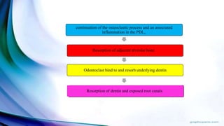 continuation of the osteoclastic process and an associated
inflammation in the PDL,.
Resorption of adjacent alveolar bone
Odontoclast bind to and resorb underlying dentin
Resorption of dentin and exposed root canals
 