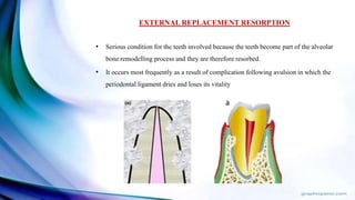 • Serious condition for the teeth involved because the teeth become part of the alveolar
bone remodelling process and they are therefore resorbed.
• It occurs most frequently as a result of complication following avulsion in which the
periodontal ligament dries and loses its vitality
EXTERNAL REPLACEMENT RESORPTION
 