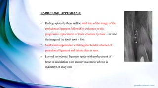 RADIOLOGIC APPEARANCE
• Radiographically there will be total loss of the image of the
periodontal ligament followed by evidence of the
progressive replacement of tooth structure by bone – in time
the image of the tooth root is lost.
• Moth eaten appearance with irregular border, absence of
periodontal ligament and lamina dura is seen.
• Loss of periodontal ligament space with replacement of
bone in association with an uneven contour of root is
indicative of ankylosis
 