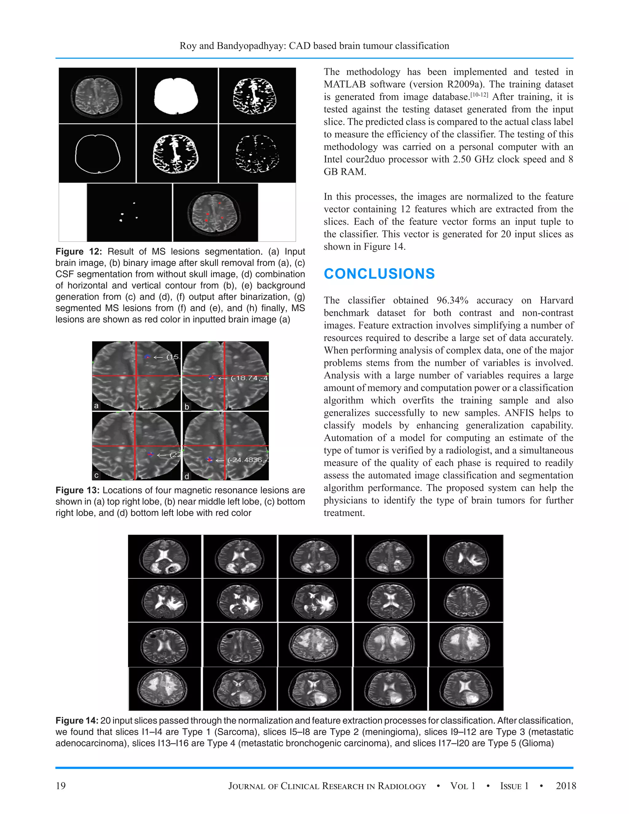 Roy and Bandyopadhyay: CAD based brain tumour classification
19 Journal of Clinical Research in Radiology  •  Vol 1  •  Issue 1  •  2018
The methodology has been implemented and tested in
MATLAB software (version R2009a). The training dataset
is generated from image database.[10-12]
After training, it is
tested against the testing dataset generated from the input
slice. The predicted class is compared to the actual class label
to measure the efficiency of the classifier. The testing of this
methodology was carried on a personal computer with an
Intel cour2duo processor with 2.50 GHz clock speed and 8
GB RAM.
In this processes, the images are normalized to the feature
vector containing 12 features which are extracted from the
slices. Each of the feature vector forms an input tuple to
the classifier. This vector is generated for 20 input slices as
shown in Figure 14.
CONCLUSIONS
The classifier obtained 96.34% accuracy on Harvard
benchmark dataset for both contrast and non-contrast
images. Feature extraction involves simplifying a number of
resources required to describe a large set of data accurately.
When performing analysis of complex data, one of the major
problems stems from the number of variables is involved.
Analysis with a large number of variables requires a large
amount of memory and computation power or a classification
algorithm which overfits the training sample and also
generalizes successfully to new samples. ANFIS helps to
classify models by enhancing generalization capability.
Automation of a model for computing an estimate of the
type of tumor is verified by a radiologist, and a simultaneous
measure of the quality of each phase is required to readily
assess the automated image classification and segmentation
algorithm performance. The proposed system can help the
physicians to identify the type of brain tumors for further
treatment.
Figure 12: Result of MS lesions segmentation. (a) Input
brain image, (b) binary image after skull removal from (a), (c)
CSF segmentation from without skull image, (d) combination
of horizontal and vertical contour from (b), (e) background
generation from (c) and (d), (f) output after binarization, (g)
segmented MS lesions from (f) and (e), and (h) finally, MS
lesions are shown as red color in inputted brain image (a)
Figure 14: 20 input slices passed through the normalization and feature extraction processes for classification. After classification,
we found that slices I1–I4 are Type 1 (Sarcoma), slices I5–I8 are Type 2 (meningioma), slices I9–I12 are Type 3 (metastatic
adenocarcinoma), slices I13–I16 are Type 4 (metastatic bronchogenic carcinoma), and slices I17–I20 are Type 5 (Glioma)
Figure 13: Locations of four magnetic resonance lesions are
shown in (a) top right lobe, (b) near middle left lobe, (c) bottom
right lobe, and (d) bottom left lobe with red color
d
c
b
a
 