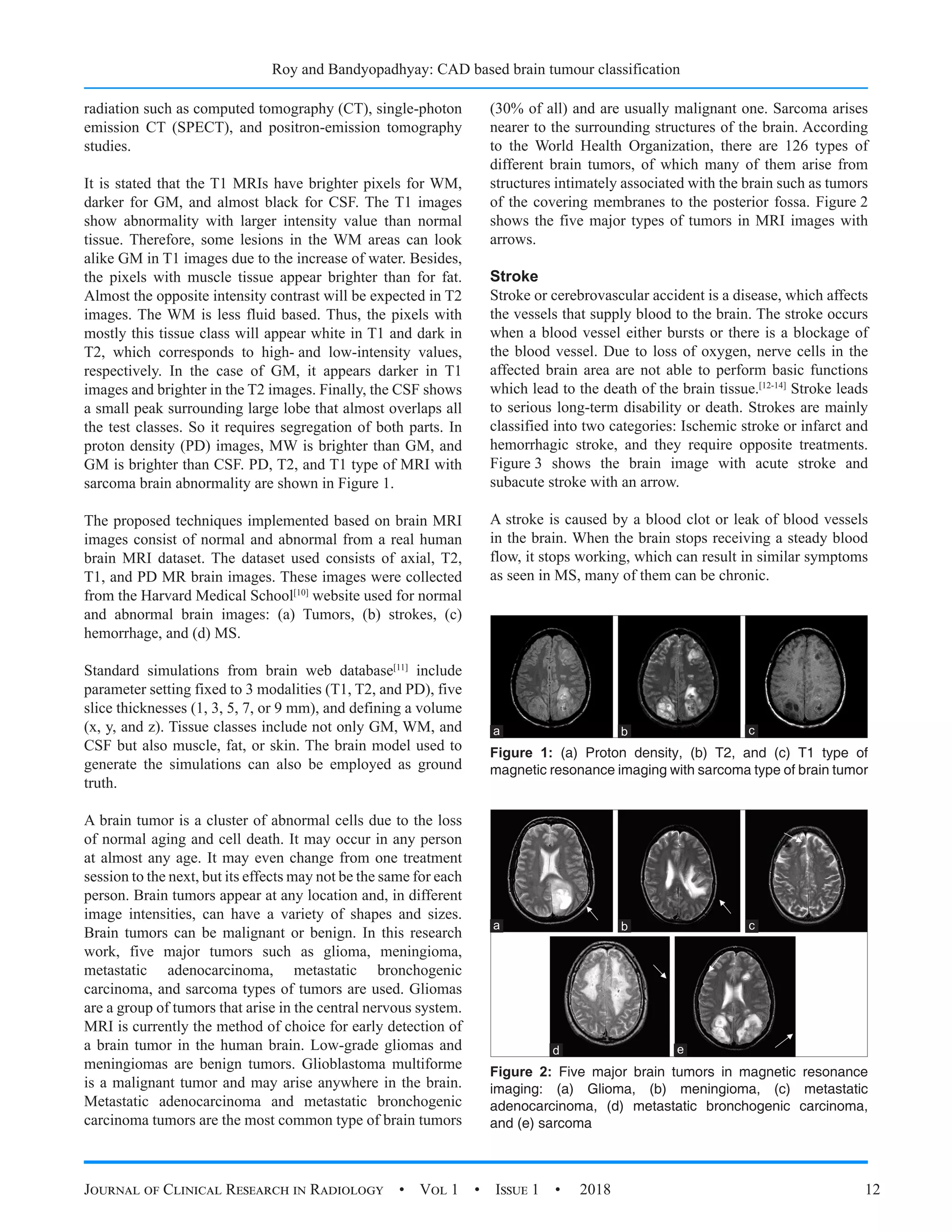 Roy and Bandyopadhyay: CAD based brain tumour classification
Journal of Clinical Research in Radiology  •  Vol 1  •  Issue 1  •  2018 12
radiation such as computed tomography (CT), single-photon
emission CT (SPECT), and positron-emission tomography
studies.
It is stated that the T1 MRIs have brighter pixels for WM,
darker for GM, and almost black for CSF. The T1 images
show abnormality with larger intensity value than normal
tissue. Therefore, some lesions in the WM areas can look
alike GM in T1 images due to the increase of water. Besides,
the pixels with muscle tissue appear brighter than for fat.
Almost the opposite intensity contrast will be expected in T2
images. The WM is less fluid based. Thus, the pixels with
mostly this tissue class will appear white in T1 and dark in
T2, which corresponds to high- and low-intensity values,
respectively. In the case of GM, it appears darker in T1
images and brighter in the T2 images. Finally, the CSF shows
a small peak surrounding large lobe that almost overlaps all
the test classes. So it requires segregation of both parts. In
proton density (PD) images, MW is brighter than GM, and
GM is brighter than CSF. PD, T2, and T1 type of MRI with
sarcoma brain abnormality are shown in Figure 1.
The proposed techniques implemented based on brain MRI
images consist of normal and abnormal from a real human
brain MRI dataset. The dataset used consists of axial, T2,
T1, and PD MR brain images. These images were collected
from the Harvard Medical School[10]
website used for normal
and abnormal brain images: (a) Tumors, (b) strokes, (c)
hemorrhage, and (d) MS.
Standard simulations from brain web database[11]
include
parameter setting fixed to 3 modalities (T1, T2, and PD), five
slice thicknesses (1, 3, 5, 7, or 9 mm), and defining a volume
(x, y, and z). Tissue classes include not only GM, WM, and
CSF but also muscle, fat, or skin. The brain model used to
generate the simulations can also be employed as ground
truth.
A brain tumor is a cluster of abnormal cells due to the loss
of normal aging and cell death. It may occur in any person
at almost any age. It may even change from one treatment
session to the next, but its effects may not be the same for each
person. Brain tumors appear at any location and, in different
image intensities, can have a variety of shapes and sizes.
Brain tumors can be malignant or benign. In this research
work, five major tumors such as glioma, meningioma,
metastatic adenocarcinoma, metastatic bronchogenic
carcinoma, and sarcoma types of tumors are used. Gliomas
are a group of tumors that arise in the central nervous system.
MRI is currently the method of choice for early detection of
a brain tumor in the human brain. Low-grade gliomas and
meningiomas are benign tumors. Glioblastoma multiforme
is a malignant tumor and may arise anywhere in the brain.
Metastatic adenocarcinoma and metastatic bronchogenic
carcinoma tumors are the most common type of brain tumors
(30% of all) and are usually malignant one. Sarcoma arises
nearer to the surrounding structures of the brain. According
to the World Health Organization, there are 126 types of
different brain tumors, of which many of them arise from
structures intimately associated with the brain such as tumors
of the covering membranes to the posterior fossa. Figure 2
shows the five major types of tumors in MRI images with
arrows.
Stroke
Stroke or cerebrovascular accident is a disease, which affects
the vessels that supply blood to the brain. The stroke occurs
when a blood vessel either bursts or there is a blockage of
the blood vessel. Due to loss of oxygen, nerve cells in the
affected brain area are not able to perform basic functions
which lead to the death of the brain tissue.[12-14]
Stroke leads
to serious long-term disability or death. Strokes are mainly
classified into two categories: Ischemic stroke or infarct and
hemorrhagic stroke, and they require opposite treatments.
Figure 3 shows the brain image with acute stroke and
subacute stroke with an arrow.
A stroke is caused by a blood clot or leak of blood vessels
in the brain. When the brain stops receiving a steady blood
flow, it stops working, which can result in similar symptoms
as seen in MS, many of them can be chronic.
Figure 1: (a) Proton density, (b) T2, and (c) T1 type of
magnetic resonance imaging with sarcoma type of brain tumor
c
b
a
Figure 2: Five major brain tumors in magnetic resonance
imaging: (a) Glioma, (b) meningioma, (c) metastatic
adenocarcinoma, (d) metastatic bronchogenic carcinoma,
and (e) sarcoma
d
c
b
a
e
 