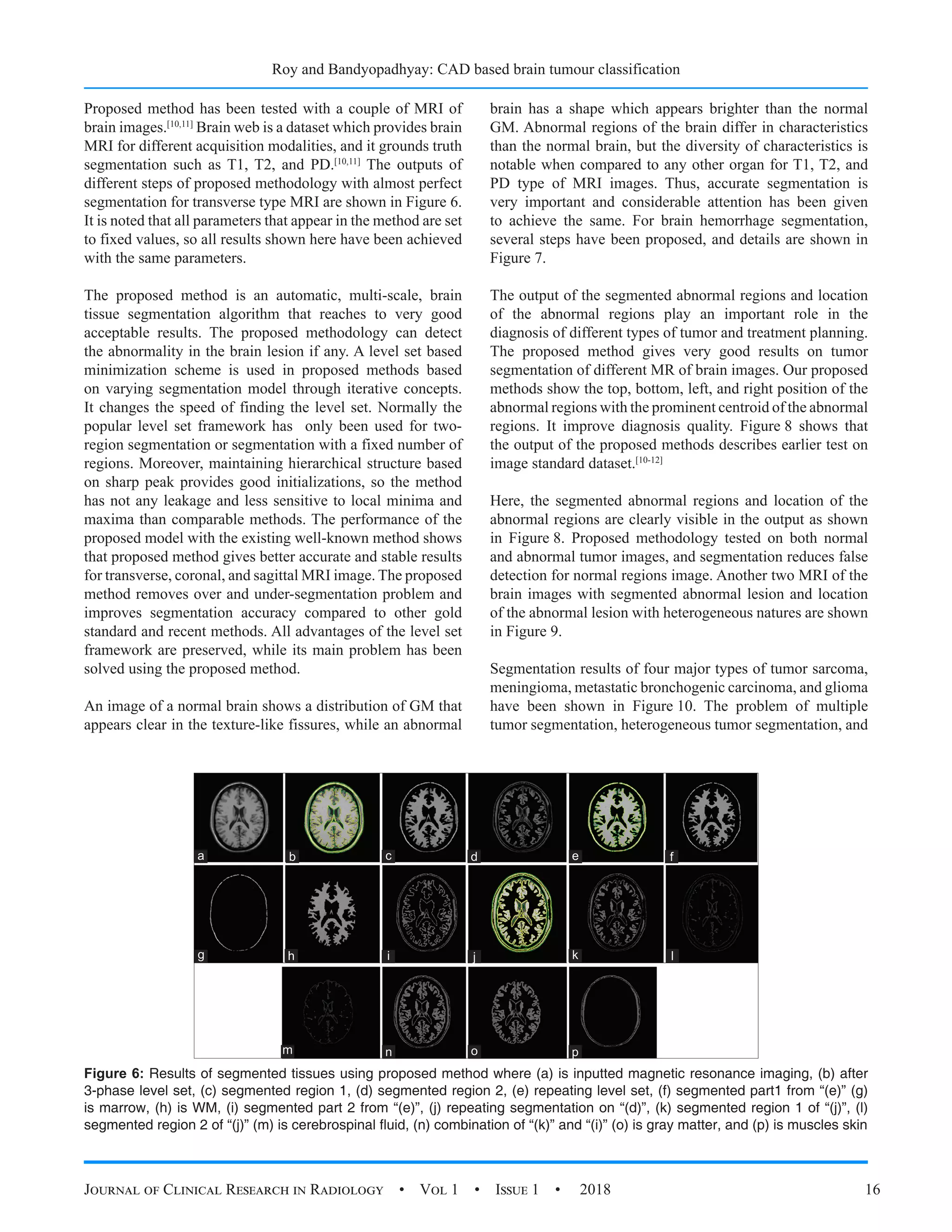 Roy and Bandyopadhyay: CAD based brain tumour classification
Journal of Clinical Research in Radiology  •  Vol 1  •  Issue 1  •  2018 16
Proposed method has been tested with a couple of MRI of
brain images.[10,11]
Brain web is a dataset which provides brain
MRI for different acquisition modalities, and it grounds truth
segmentation such as T1, T2, and PD.[10,11]
The outputs of
different steps of proposed methodology with almost perfect
segmentation for transverse type MRI are shown in Figure 6.
It is noted that all parameters that appear in the method are set
to fixed values, so all results shown here have been achieved
with the same parameters.
The proposed method is an automatic, multi-scale, brain
tissue segmentation algorithm that reaches to very good
acceptable results. The proposed methodology can detect
the abnormality in the brain lesion if any. A level set based
minimization scheme is used in proposed methods based
on varying segmentation model through iterative concepts.
It changes the speed of finding the level set. Normally the
popular level set framework has only been used for two-
region segmentation or segmentation with a fixed number of
regions. Moreover, maintaining hierarchical structure based
on sharp peak provides good initializations, so the method
has not any leakage and less sensitive to local minima and
maxima than comparable methods. The performance of the
proposed model with the existing well-known method shows
that proposed method gives better accurate and stable results
for transverse, coronal, and sagittal MRI image. The proposed
method removes over and under-segmentation problem and
improves segmentation accuracy compared to other gold
standard and recent methods. All advantages of the level set
framework are preserved, while its main problem has been
solved using the proposed method.
An image of a normal brain shows a distribution of GM that
appears clear in the texture-like fissures, while an abnormal
brain has a shape which appears brighter than the normal
GM. Abnormal regions of the brain differ in characteristics
than the normal brain, but the diversity of characteristics is
notable when compared to any other organ for T1, T2, and
PD type of MRI images. Thus, accurate segmentation is
very important and considerable attention has been given
to achieve the same. For brain hemorrhage segmentation,
several steps have been proposed, and details are shown in
Figure 7.
The output of the segmented abnormal regions and location
of the abnormal regions play an important role in the
diagnosis of different types of tumor and treatment planning.
The proposed method gives very good results on tumor
segmentation of different MR of brain images. Our proposed
methods show the top, bottom, left, and right position of the
abnormal regions with the prominent centroid of the abnormal
regions. It improve diagnosis quality. Figure 8 shows that
the output of the proposed methods describes earlier test on
image standard dataset.[10-12]
Here, the segmented abnormal regions and location of the
abnormal regions are clearly visible in the output as shown
in Figure 8. Proposed methodology tested on both normal
and abnormal tumor images, and segmentation reduces false
detection for normal regions image. Another two MRI of the
brain images with segmented abnormal lesion and location
of the abnormal lesion with heterogeneous natures are shown
in Figure 9.
Segmentation results of four major types of tumor sarcoma,
meningioma, metastatic bronchogenic carcinoma, and glioma
have been shown in Figure 10. The problem of multiple
tumor segmentation, heterogeneous tumor segmentation, and
Figure 6: Results of segmented tissues using proposed method where (a) is inputted magnetic resonance imaging, (b) after
3-phase level set, (c) segmented region 1, (d) segmented region 2, (e) repeating level set, (f) segmented part1 from “(e)” (g)
is marrow, (h) is WM, (i) segmented part 2 from “(e)”, (j) repeating segmentation on “(d)”, (k) segmented region 1 of “(j)”, (l)
segmented region 2 of “(j)” (m) is cerebrospinal fluid, (n) combination of “(k)” and “(i)” (o) is gray matter, and (p) is muscles skin
d
j
p
h
n
c
i
o
g
m
b f
l
a e
k
 