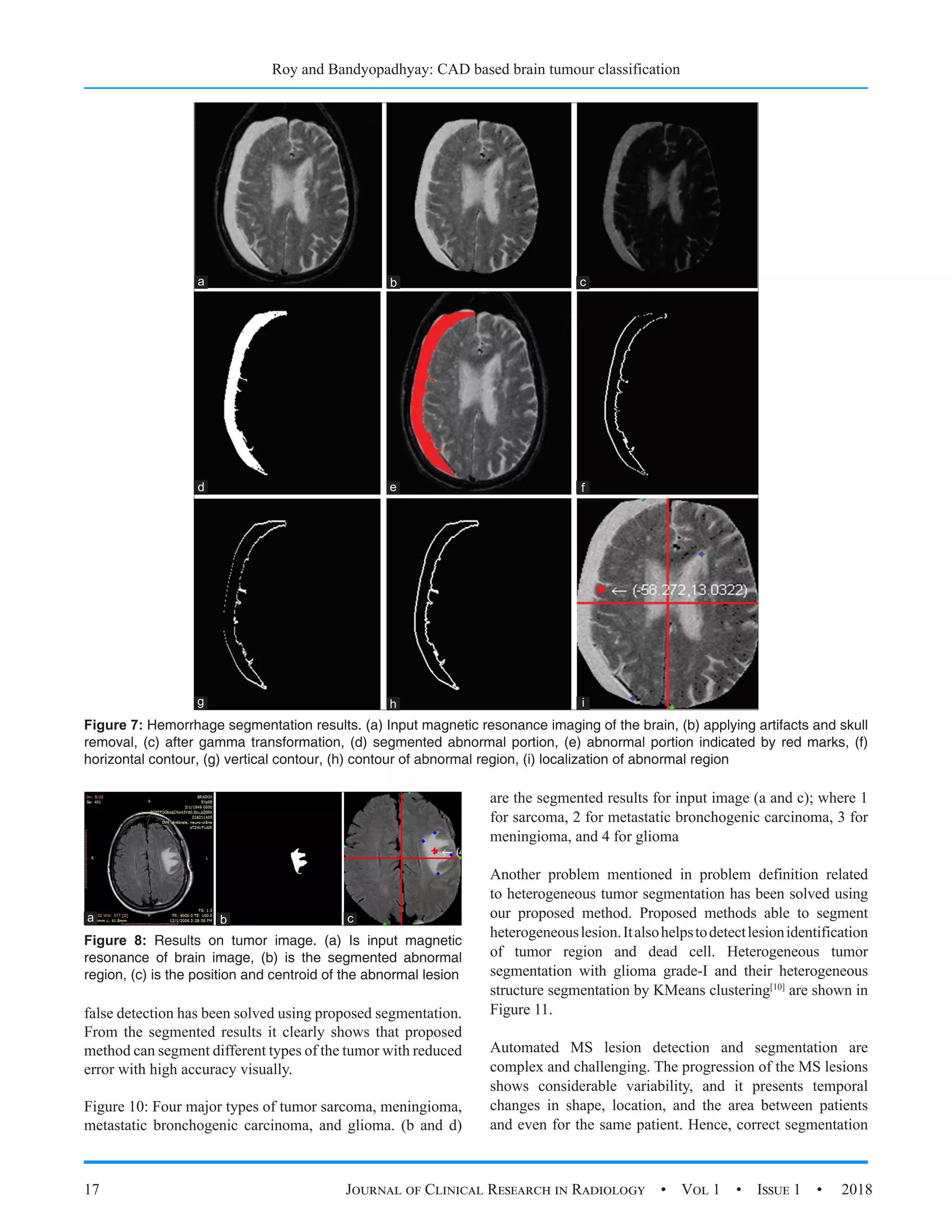 Roy and Bandyopadhyay: CAD based brain tumour classification
17 Journal of Clinical Research in Radiology  •  Vol 1  •  Issue 1  •  2018
false detection has been solved using proposed segmentation.
From the segmented results it clearly shows that proposed
method can segment different types of the tumor with reduced
error with high accuracy visually.
Figure 10: Four major types of tumor sarcoma, meningioma,
metastatic bronchogenic carcinoma, and glioma. (b and d)
are the segmented results for input image (a and c); where 1
for sarcoma, 2 for metastatic bronchogenic carcinoma, 3 for
meningioma, and 4 for glioma
Another problem mentioned in problem definition related
to heterogeneous tumor segmentation has been solved using
our proposed method. Proposed methods able to segment
heterogeneouslesion.Italsohelpstodetectlesionidentification
of tumor region and dead cell. Heterogeneous tumor
segmentation with glioma grade-I and their heterogeneous
structure segmentation by KMeans clustering[10]
are shown in
Figure 11.
Automated MS lesion detection and segmentation are
complex and challenging. The progression of the MS lesions
shows considerable variability, and it presents temporal
changes in shape, location, and the area between patients
and even for the same patient. Hence, correct segmentation
Figure 8: Results on tumor image. (a) Is input magnetic
resonance of brain image, (b) is the segmented abnormal
region, (c) is the position and centroid of the abnormal lesion
c
b
a
Figure 7: Hemorrhage segmentation results. (a) Input magnetic resonance imaging of the brain, (b) applying artifacts and skull
removal, (c) after gamma transformation, (d) segmented abnormal portion, (e) abnormal portion indicated by red marks, (f)
horizontal contour, (g) vertical contour, (h) contour of abnormal region, (i) localization of abnormal region
d
h
c
g
b
f
a
i
e
 