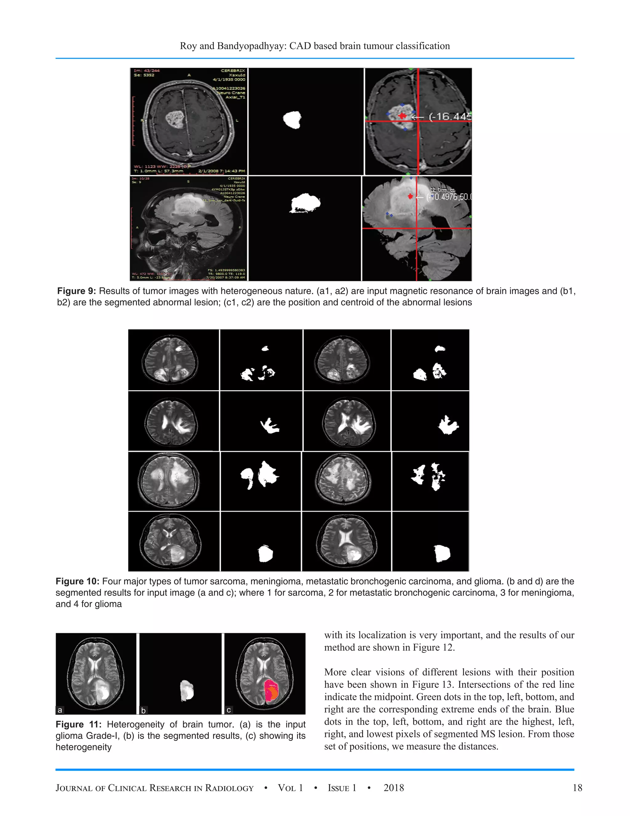 Roy and Bandyopadhyay: CAD based brain tumour classification
Journal of Clinical Research in Radiology  •  Vol 1  •  Issue 1  •  2018 18
Figure 9: Results of tumor images with heterogeneous nature. (a1, a2) are input magnetic resonance of brain images and (b1,
b2) are the segmented abnormal lesion; (c1, c2) are the position and centroid of the abnormal lesions
Figure 10: Four major types of tumor sarcoma, meningioma, metastatic bronchogenic carcinoma, and glioma. (b and d) are the
segmented results for input image (a and c); where 1 for sarcoma, 2 for metastatic bronchogenic carcinoma, 3 for meningioma,
and 4 for glioma
with its localization is very important, and the results of our
method are shown in Figure 12.
More clear visions of different lesions with their position
have been shown in Figure 13. Intersections of the red line
indicate the midpoint. Green dots in the top, left, bottom, and
right are the corresponding extreme ends of the brain. Blue
dots in the top, left, bottom, and right are the highest, left,
right, and lowest pixels of segmented MS lesion. From those
set of positions, we measure the distances.
Figure 11: Heterogeneity of brain tumor. (a) is the input
glioma Grade-I, (b) is the segmented results, (c) showing its
heterogeneity
c
b
a
 