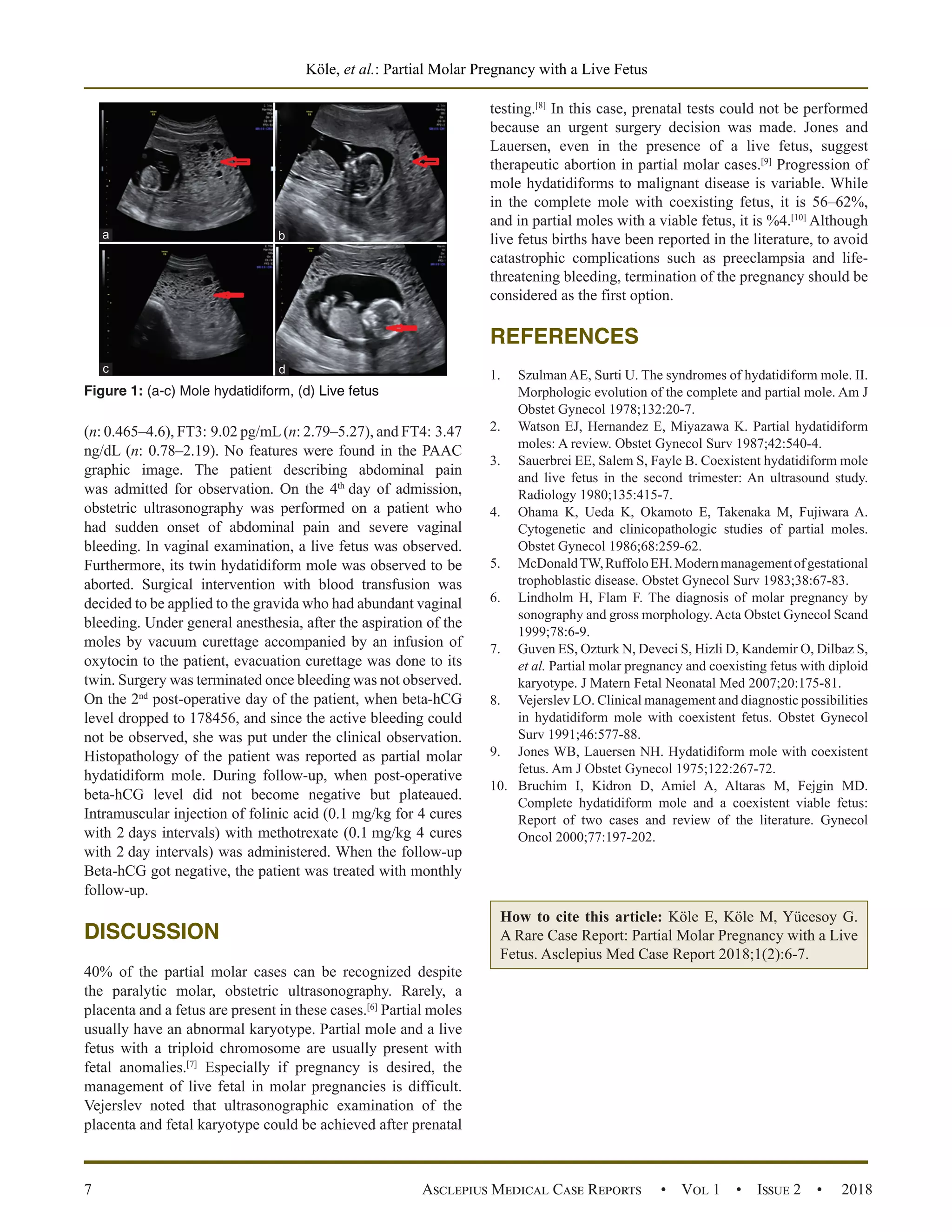 A Rare Case Report: Partial Molar Pregnancy with a Live Fetus