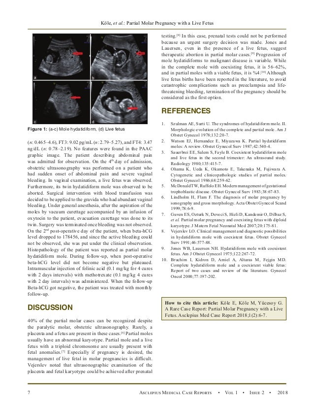 A Rare Case Report: Partial Molar Pregnancy with a Live Fetus