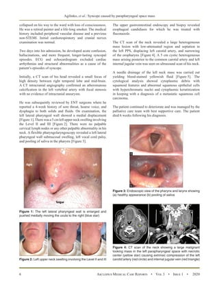 A Sinister Cause for Recurrent Syncope: Metastatic Parapharyngeal Space ...