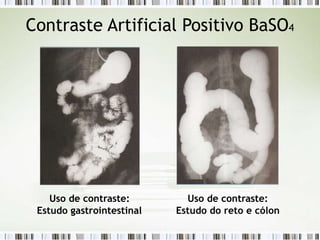 Contraste Artificial Positivo BaSO4
Uso de contraste: Uso de contraste:
Estudo gastrointestinal Estudo do reto e cólon
 
