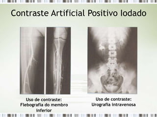 Contraste Artificial Positivo Iodado
Uso de contraste: Uso de contraste:
Flebografia do membro Urografia intravenosa
inferior
 