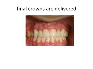 final crowns are delivered
 