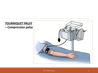 TOURNIQUET PALSY
– Compression palsy
P/B :- DR NIYATI PATEL 5
 