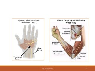 Cubital Tunnel Syndrome/ Tardy
Ulnar Palsy
P/B :- DR NIYATI PATEL 7
 
