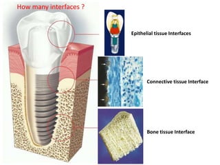 2. Periimplantitis 2017.pptx