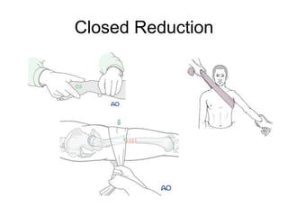 GENERAL PRINCIPLES OF CLOSED AND OPEN FRACTURES | PPT