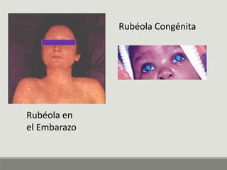 Fruth Rubeola Rubeola | PDF