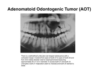 Adenomatoid Odontogenic Tumor (AOT)
There is a well-defined unilocular oval shaped radiolucence with a
corticated margin. It extend from apex of tooth 21 to apex of tooth 25 and
from 3mm below alveolar crest to nasal spine level,measuring
approximately 55 x 4 cm in diameter. It causes tooth 21 and tooth 23
unerupted, tooth 21 malposition (slant to mesisal) and tooth 24 slanted to
distal.
 