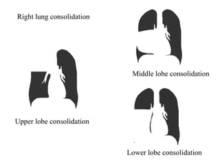 Upper lobe consolidation
Middle lobe consolidation
Lower lobe consolidation
Right lung consolidation
 