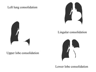 Upper lobe consolidation
Lingular consolidation
Lower lobe consolidation
Left lung consolidation
 