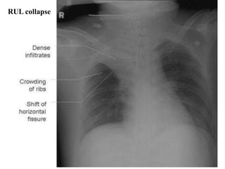 RUL collapse
 