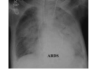 ARDS
 