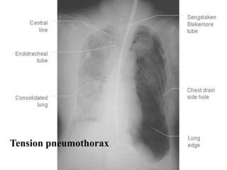 Tension pneumothorax
 