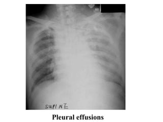Pleural effusions
 
