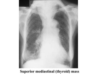 Superior mediastinal (thyroid) mass
 