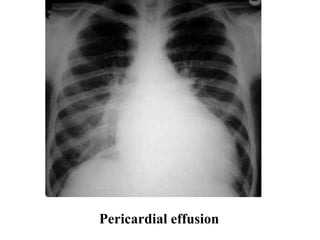 Pericardial effusion
 