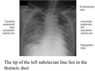 The tip of the left subclavian line lies in the
thoracic duct
 