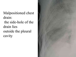 Malpositioned chest
drain:
the side-hole of the
drain lies
outside the pleural
cavity
 
