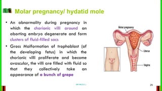 Molar pregnancy/ hydatid mole
• An abnormality during pregnancy in
which the chorionic villi around an
aborting embryo deg...