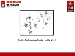 12
Positive Teichmann confirmatory test for blood
 