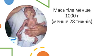 Маса тіла менше
1000 г
(менше 28 тижнів)
 