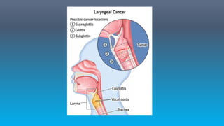 2. laryngeal Cancer  - easy explanation