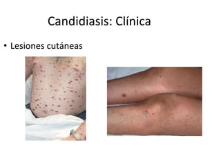 Candidiasis: Clínica
• Lesiones cutáneas
 
