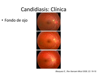 Candidiasis: Clínica
• Fondo de ojo
Blazquez E , Rev Iberoam Micol 2006; 23: 16-19
 