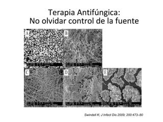 Swindell K; J Infect Dis 2009; 200:473–80
Terapia Antifúngica:
No olvidar control de la fuente
 